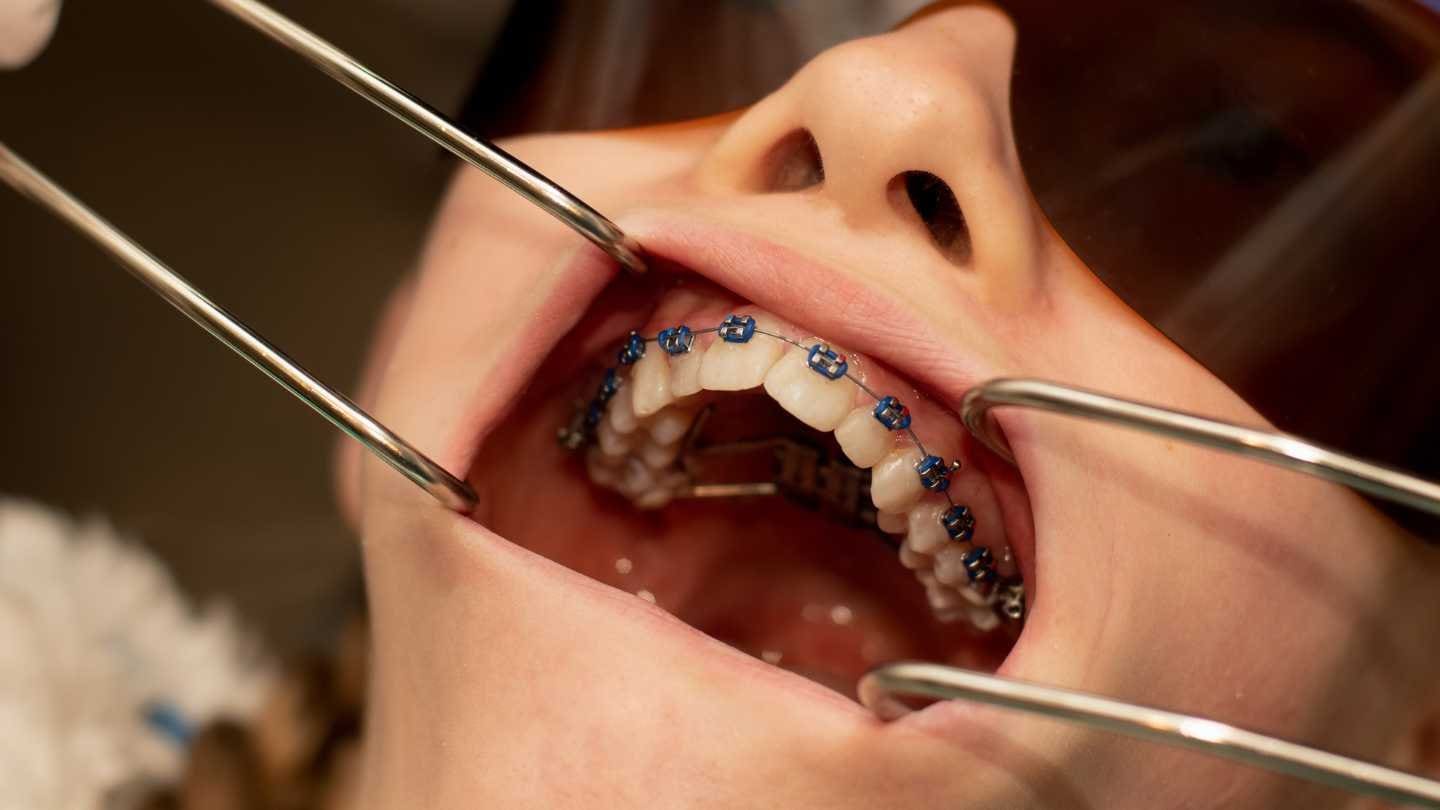 What Exactly Is a Palatal Expander?
