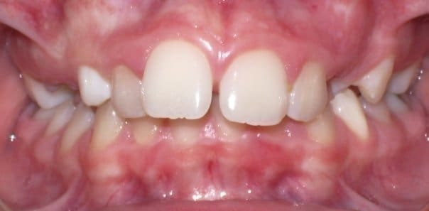 Before orthodontic treatment — Patient E