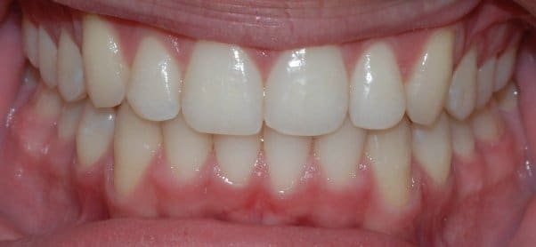 After orthodontic treatment — Patient F