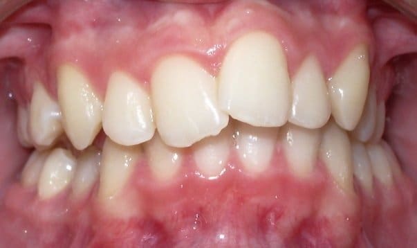 Before orthodontic treatment — Patient F