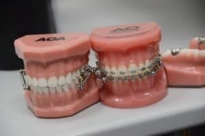 Top 10 Questions Kids Ask About Getting Braces (And How to Answer Them)