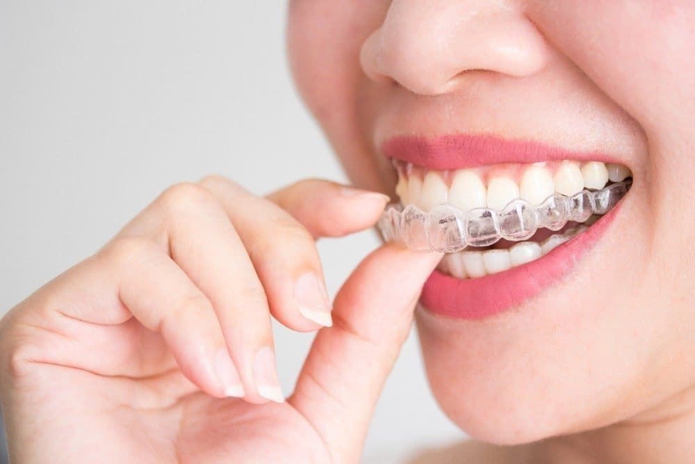 How do Spark Clear Aligners work?