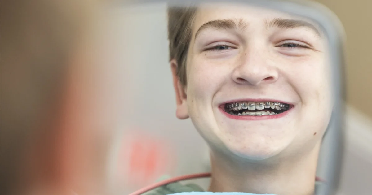 Explore the not so Traditional Metal Braces for Kids and Teens in Milwaukee from KLOwen Braces that are customized for ever patient