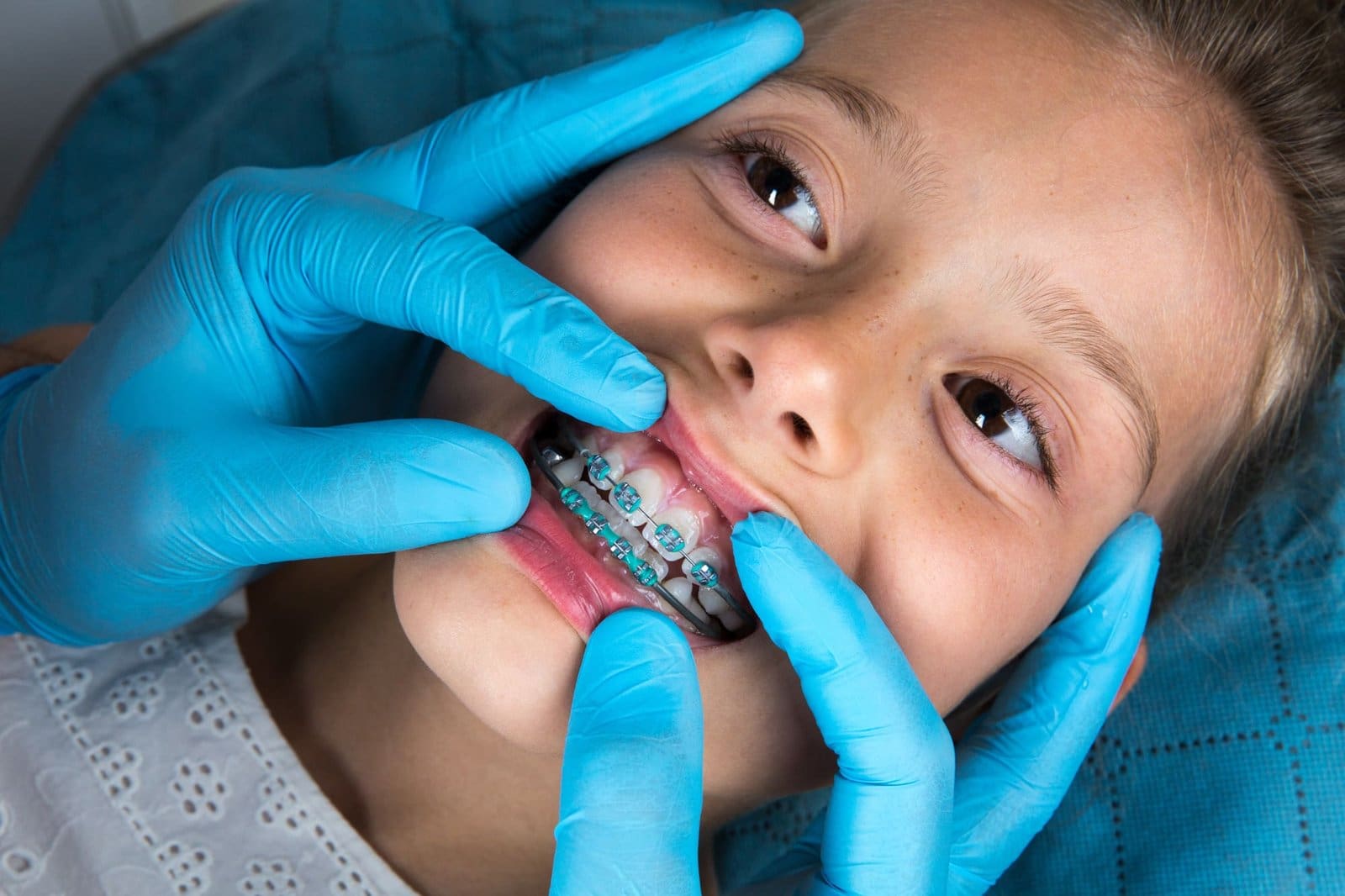 Metal Braces for All Ages