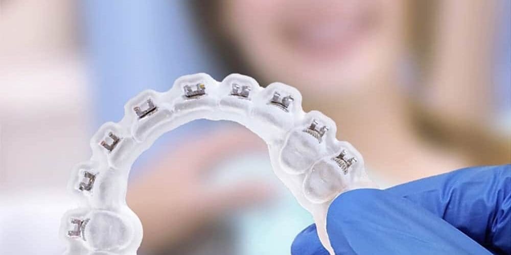 How are KLOwen braces different from traditional metal braces?