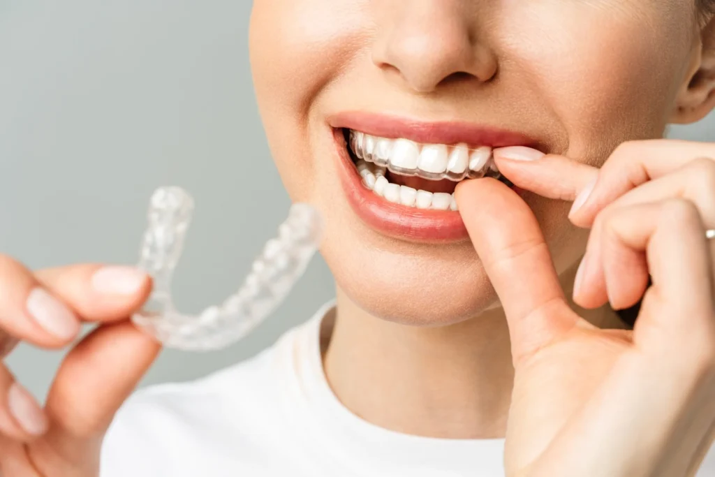 Spark Clear Aligners in West & South Milwaukee for Kids, Teens & Adults