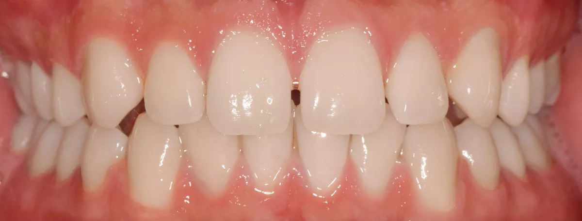Before treatment condition