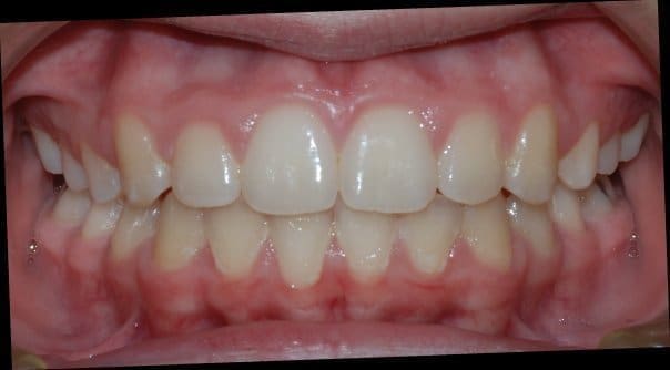 After treatment result for Patient E