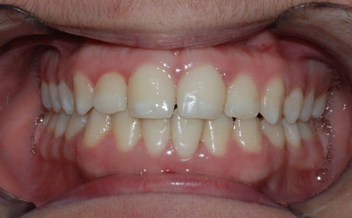After treatment result for Patient G