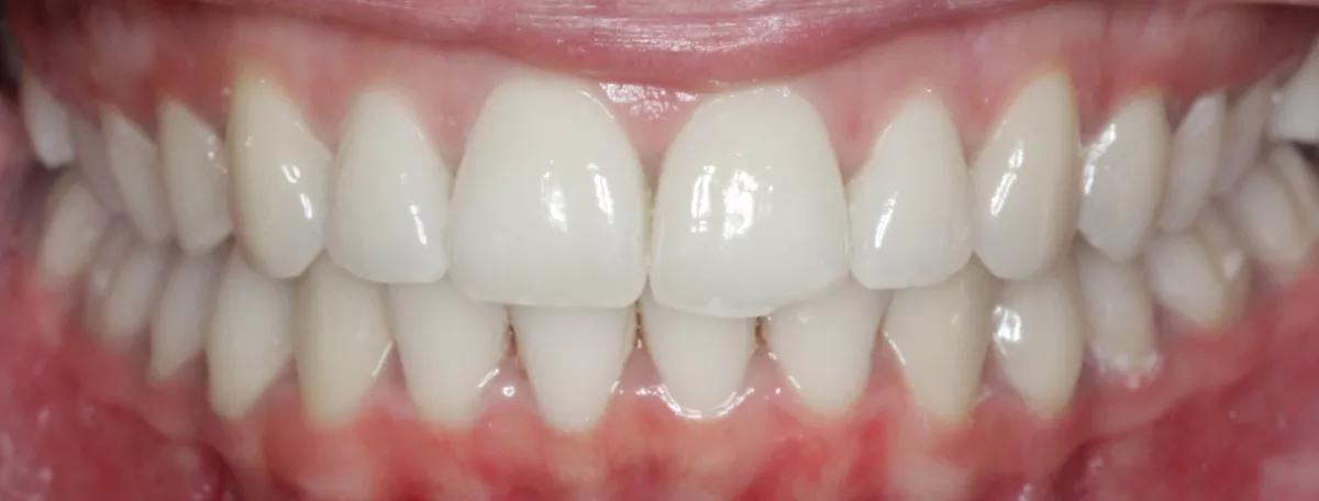 After treatment result for Patient X