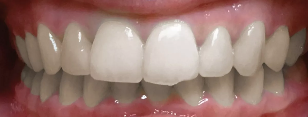 Before treatment condition